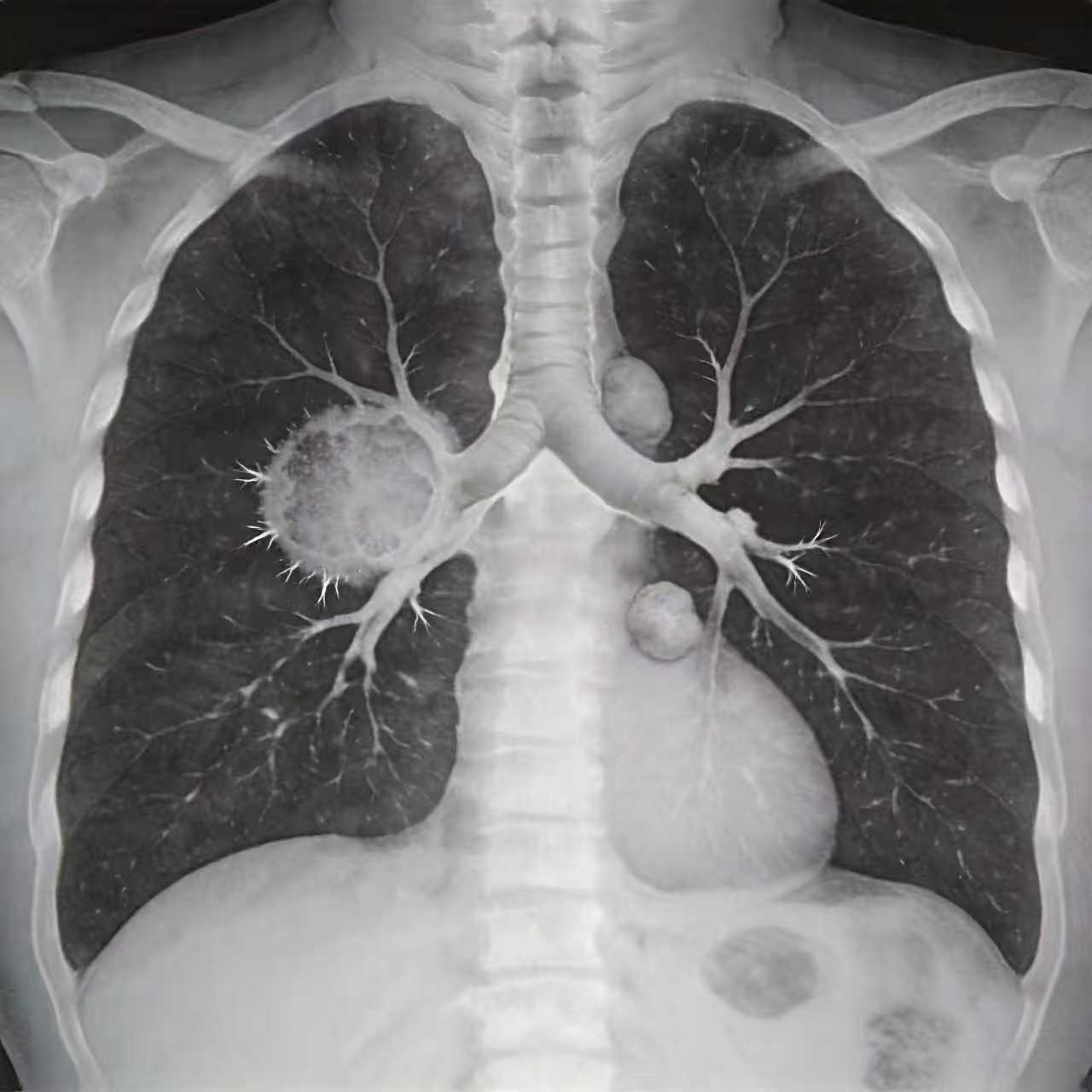 肺部CT疾病检测